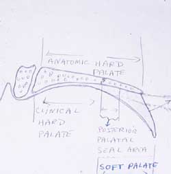 posterior palatal seal